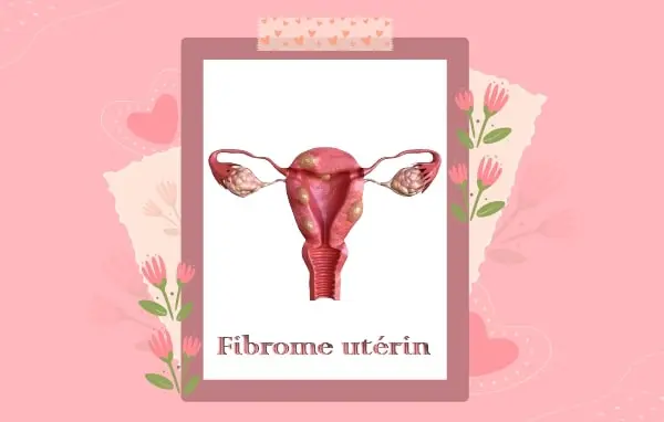 fibrome utérin