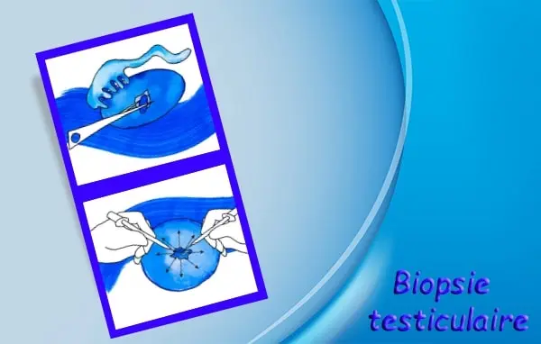 Biopsie Testiculaire